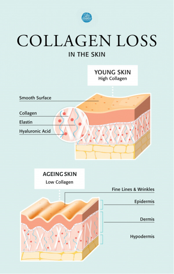 Collagen loss in the skin. Young skin has high collagen content. Image depicts a cross-section of young skin showing a smooth surface, collagen and elastin fibres, and hyaluronic acid.

Ageing skin has low collagen. Image depicts a cross-section of ageing skin showing fine lines and wrinkles in the epidermis and dermis.
